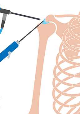 shoulder arthroscopy